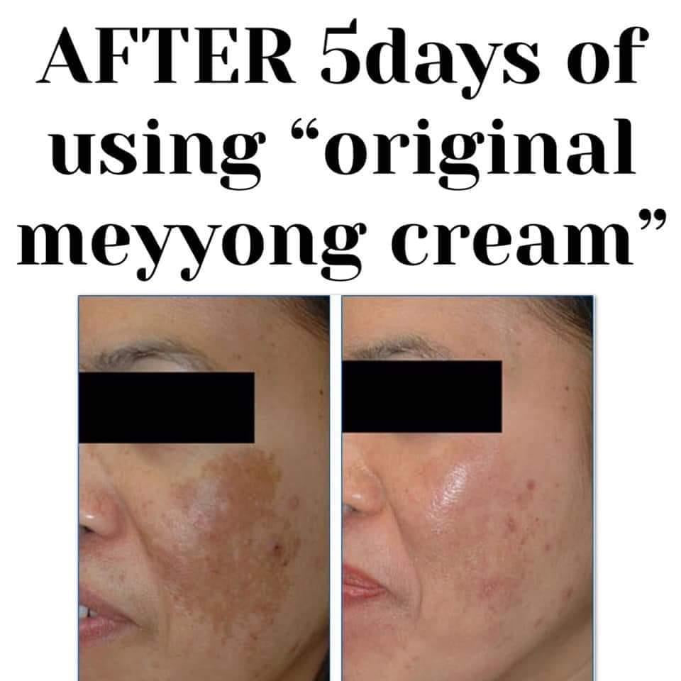 Meiyong / Meyyong Super Whitening Cream Set – My Care Kits