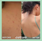 Oxecure - Sulfur Soap 100g