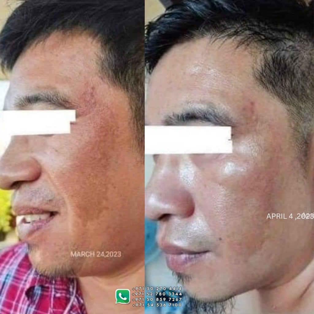 Her Choice PH - Pekas Remover Cream 50g