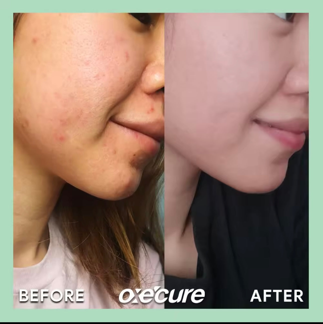 Oxecure - Acne Clear Potion 15 ML