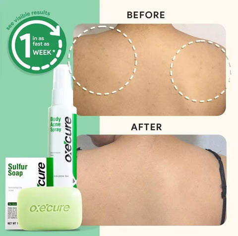 Oxecure - Body Acne Spray 25 ml