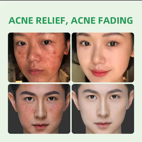 GMEELAN - Tea Tree Acne Spot Romoval Gel Anti-Acne - Reduce Redness - Repairing - 20g