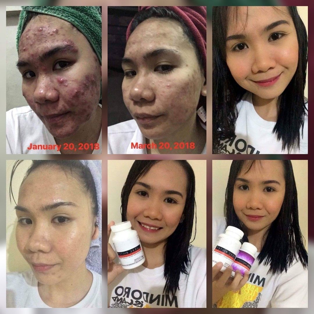 Luxxe White Ultima Glutathione + Collagen 1400 mg 60 Capsules Suppleme My Care Kits Luxxe White Ultima Glutathione + Collagen 1400 mg 60 Capsules Suppleme My Care Kits