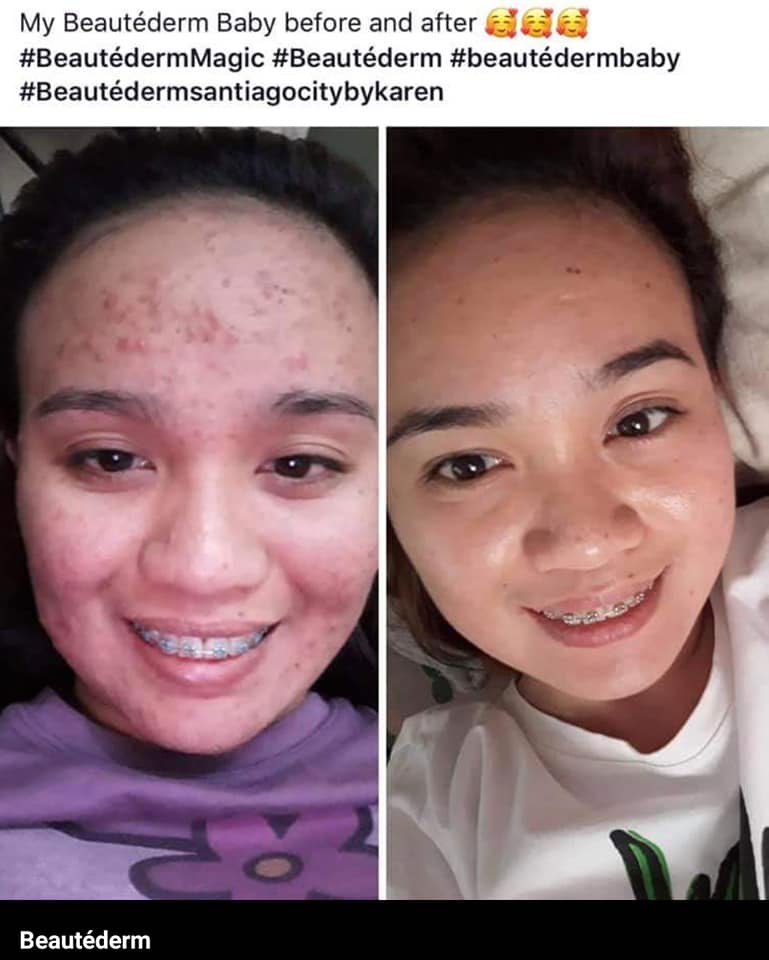 Beautederm Regular Set with upgraded toner 120ml ( large ) - My Care Kits