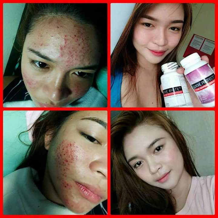 luxxe white enhanced glutathione price LUXXE WHITE ULTIMA 60s 30s 1400MG GLUTATHIONE WITH COLLAGEN AND NIACINAMIDE  FRONTROW PAMPAPUTI main image 1