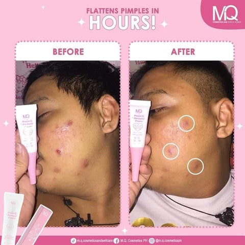MQ Cosmetics - Pimple and Dark Spots Eraser 10g
