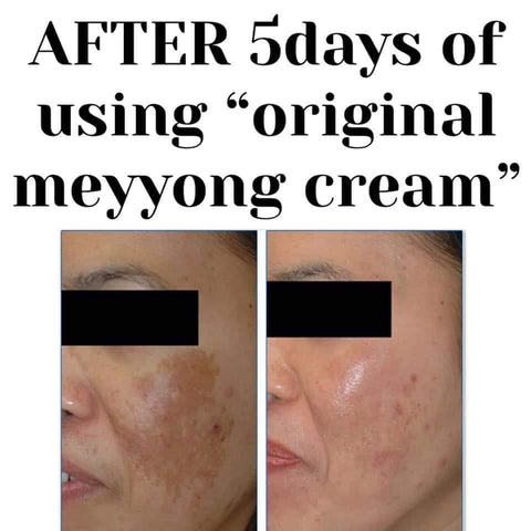 Meiyong / Meyyong Super Whitening Cream Set