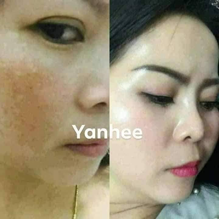Dr. Yanhee - Melasma Treatment Facial Set - BLUE SET - My Care Kits