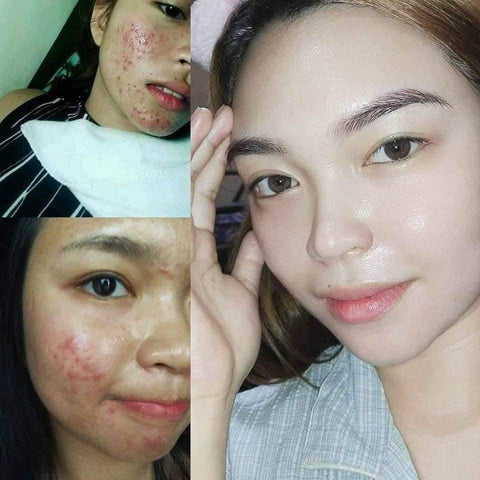 Dr. Yanhee Facial Set - Acne set - GREEN SET