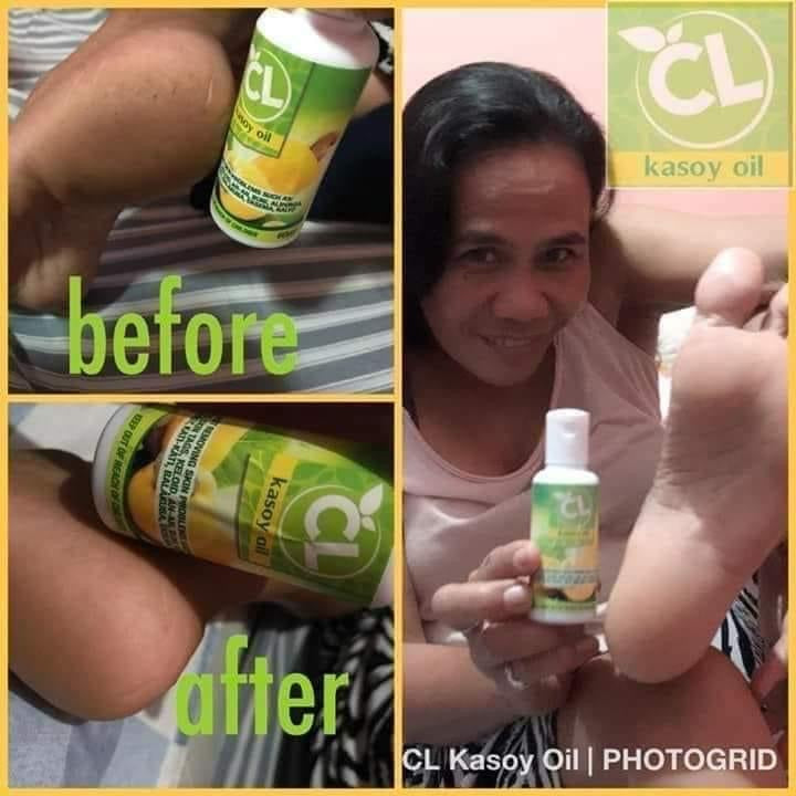 CL Kasoy Oil 60ml - My Care Kits