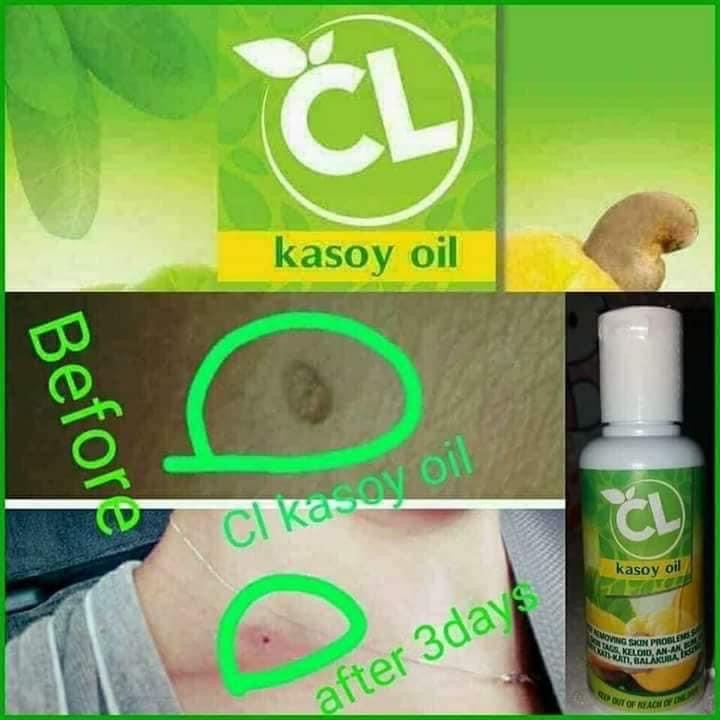 CL Kasoy Oil 60ml - My Care Kits