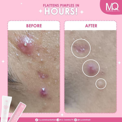 MQ Cosmetics - Pimple and Dark Spots Eraser 10g