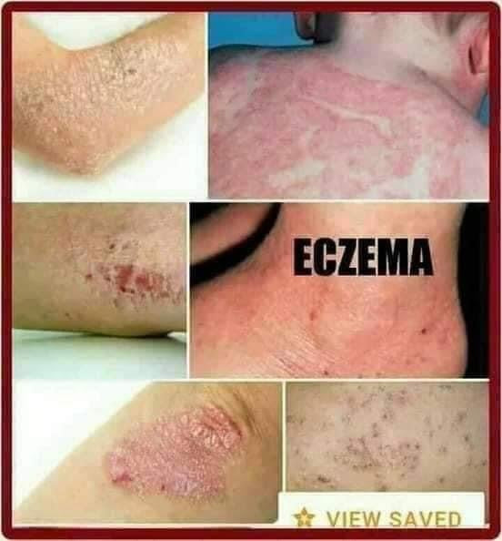 LS BL Cream 7g - My Care Kits