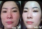 Dr. Yanhee - Melasma Treatment Facial Set - BLUE SET - My Care Kits