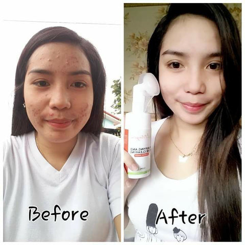 Skin Magical Purifying and Acne Clearing Facial Foaming Wash